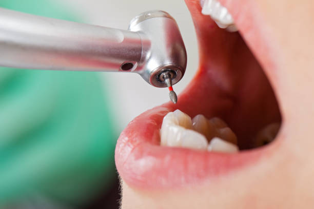 Best Emergency Wisdom Tooth Extraction in Merritt Island, FL